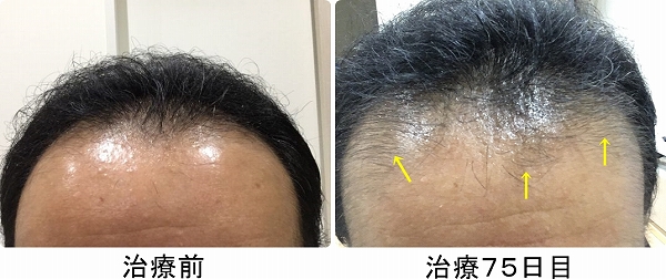 ハゲは治る aga治療60日目から効果が出始めた ド素人がはじめたdiy ハゲは治る aga治療60日目から効果が出始めた ド素人がはじめたdiy